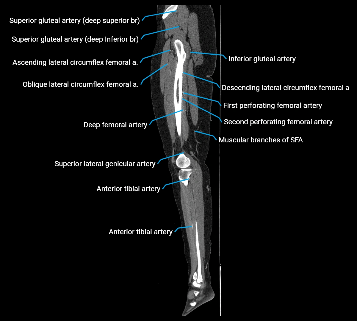 CTA lower limb sagittal cross sectional anatomy labelled image _51 (3).webp